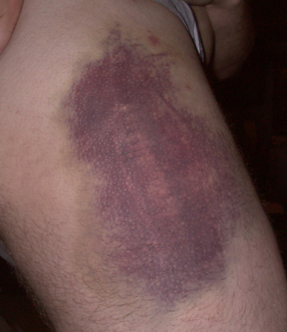 Deep Thigh Bruise